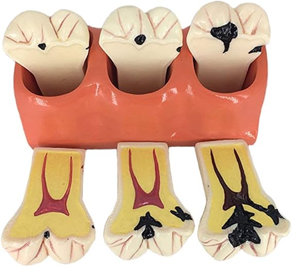 Dental Model - 4 Times Caries Teeth Disassembling Model - Brushing Flossing Practice Tooth Decay Evolution Display Tools for Teaching and Study